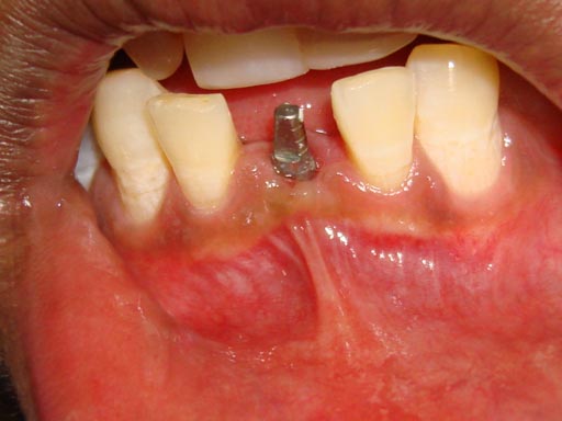 LASER DENTIST INDIA