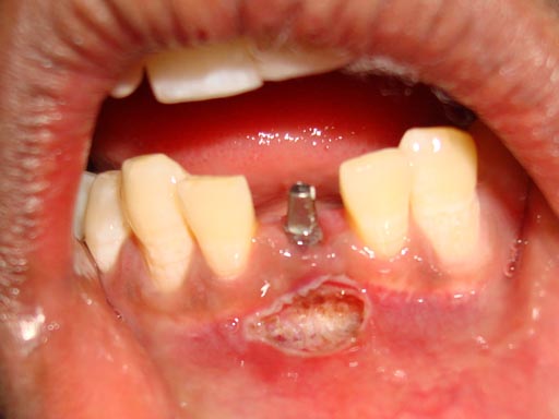 LASER DENTISTRY AHMEDABAD