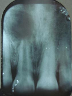 root canal treatment ahmedabad