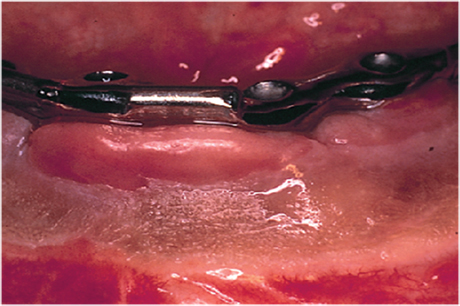 Implant Failure Treatment Ahmedabad