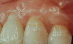 gum recession surgery ahmedabad india