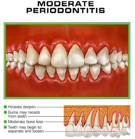gum treatment india